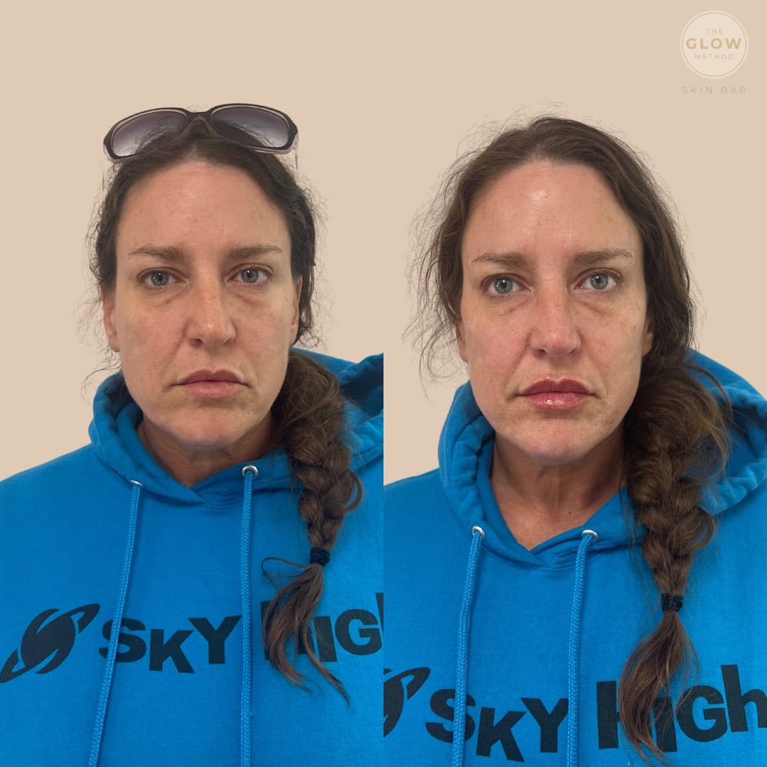 The Lipo Method photo 4