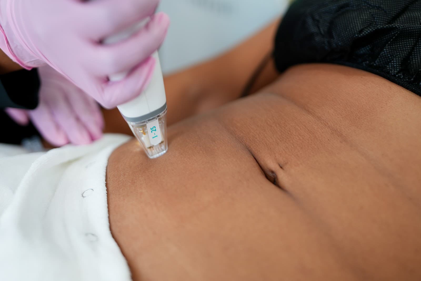 LaserAway Scarsdale