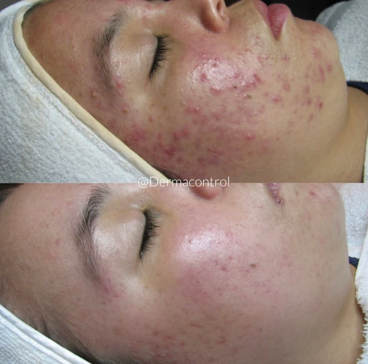 Dermacontrol