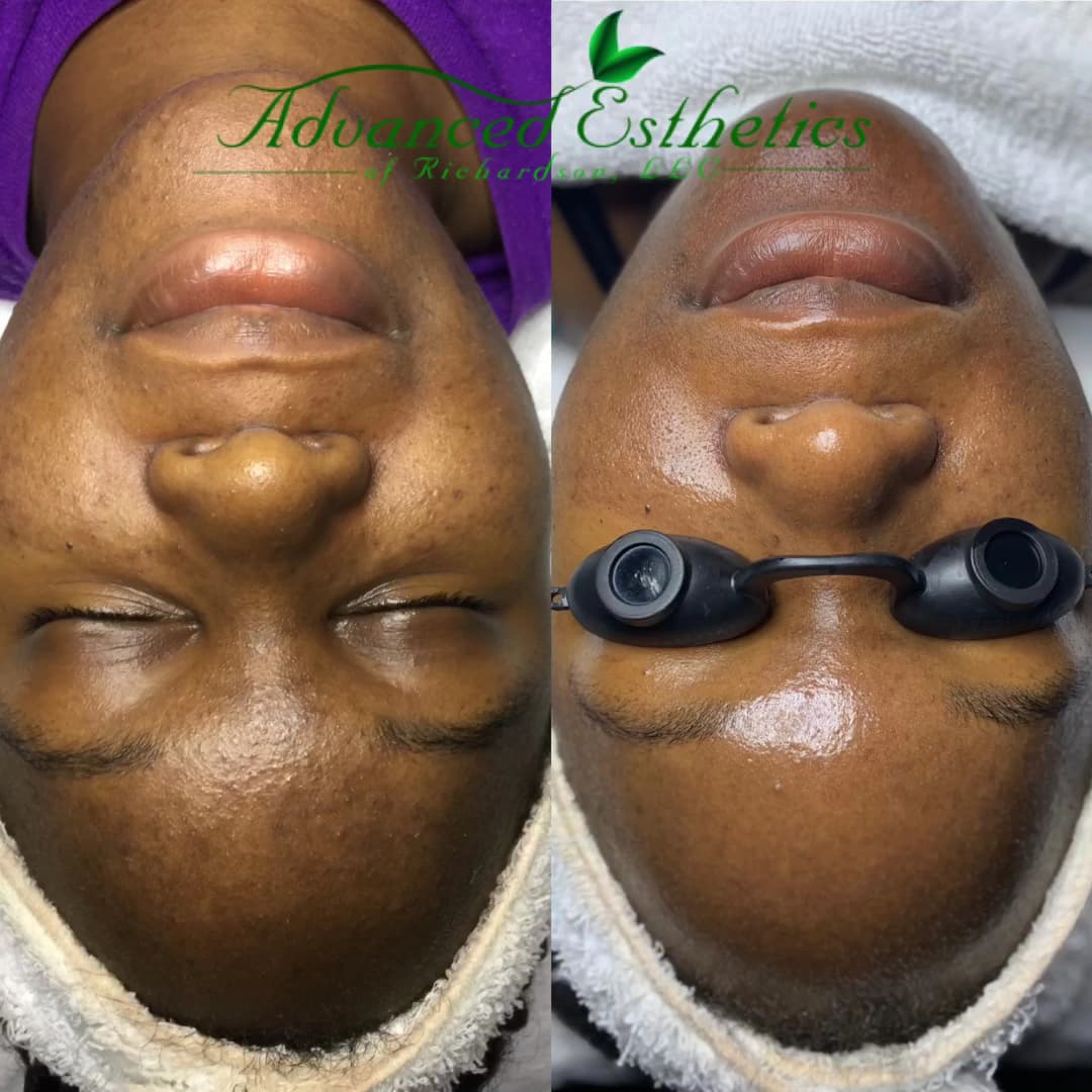 Advanced Esthetics of Richardson, LLC