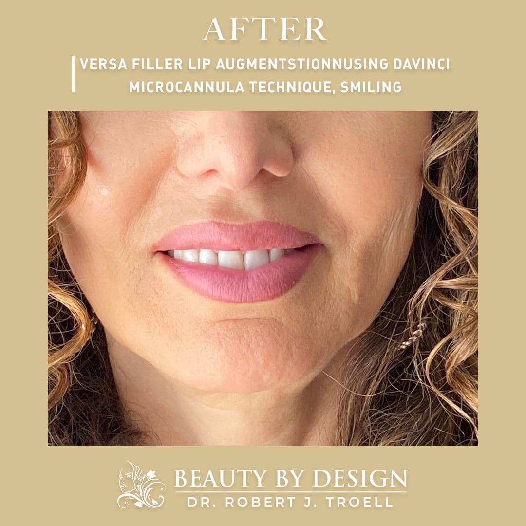 Las Vegas Beauty by Design Med Spa: Bellafill, Botox, CO2 Laser