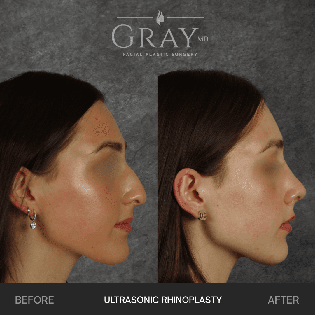 Gray Facial Plastic Surgery photo 1 of 8