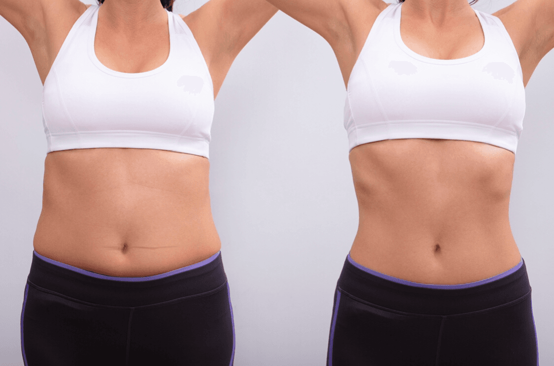 NJ Center for CoolSculpting