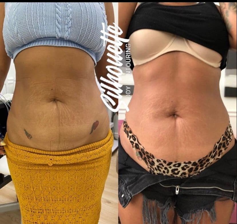 Silhouette Body Contouring