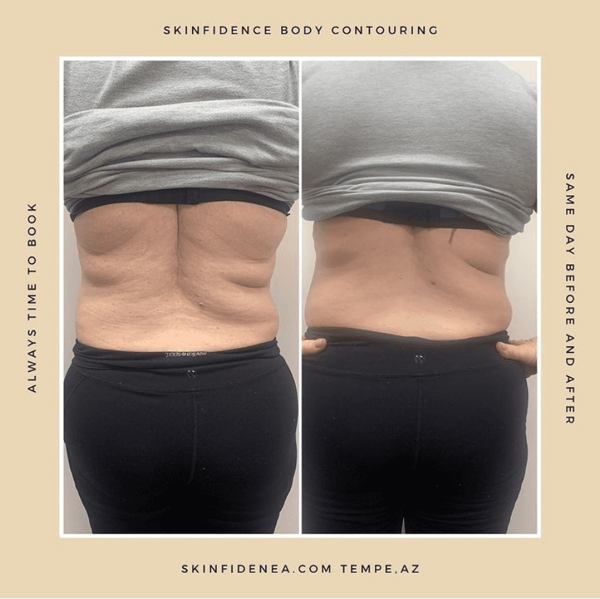 Skinfidence Az