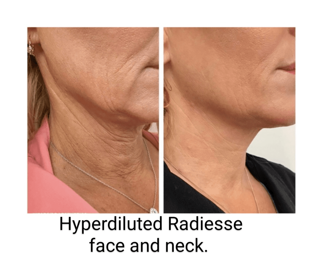 Aesthetic Nurse Laurie - Laurie Peterson RN, CANS - Aesthetic Injector, Carlsbad