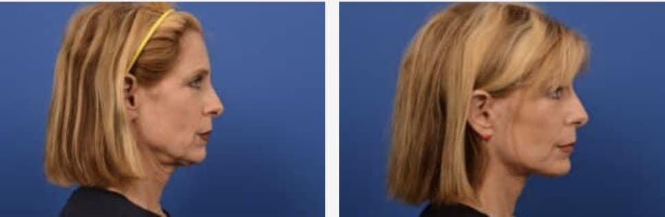 Center For Advanced Facial Plastic Surgery