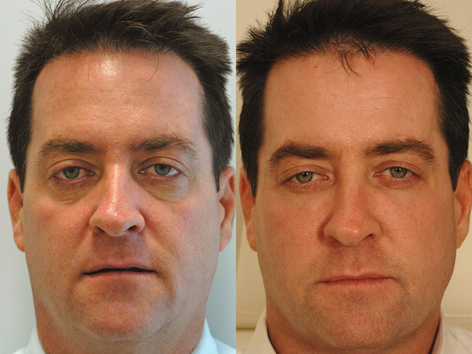 Celibre Medical ; Botox, Restylane, Juvederm, Dysport Injections | IPL photo 1 of 8