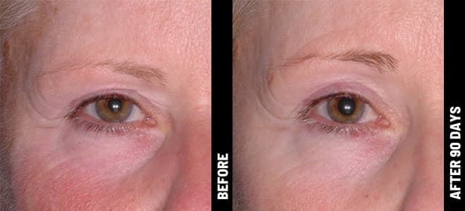 Ultherapy Med Spa