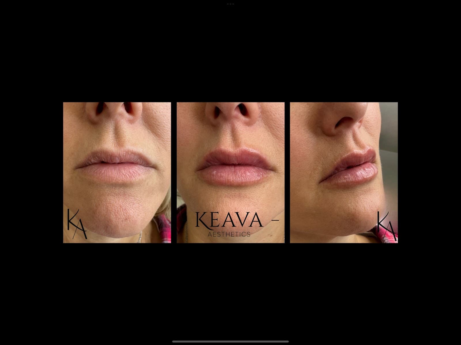 Keava Aesthetics