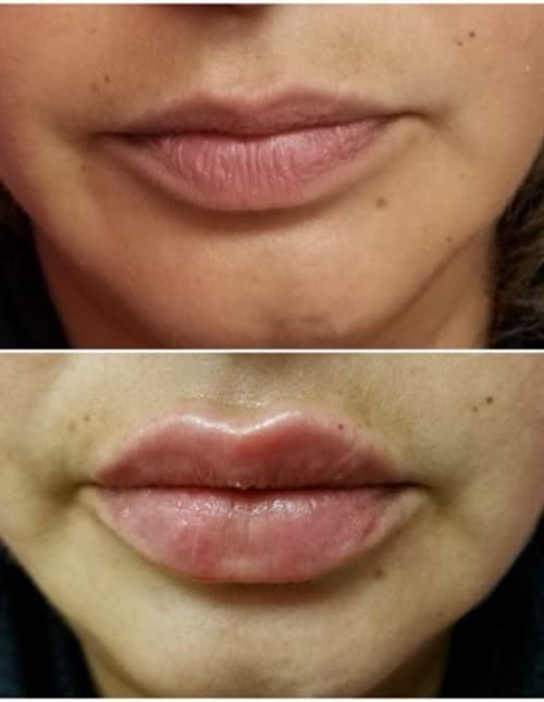 Injections By Sabina