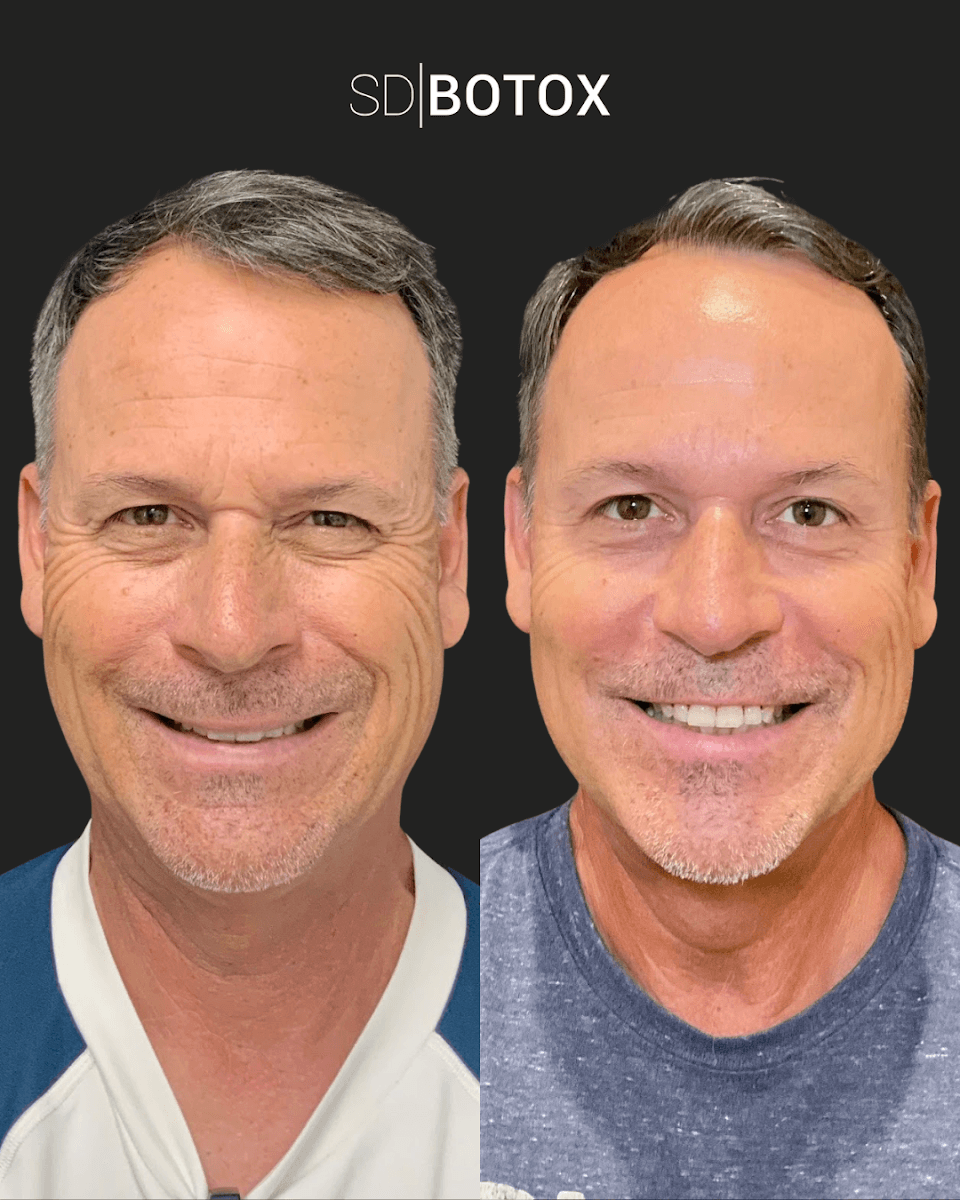 SDBotox - Pacific Beach