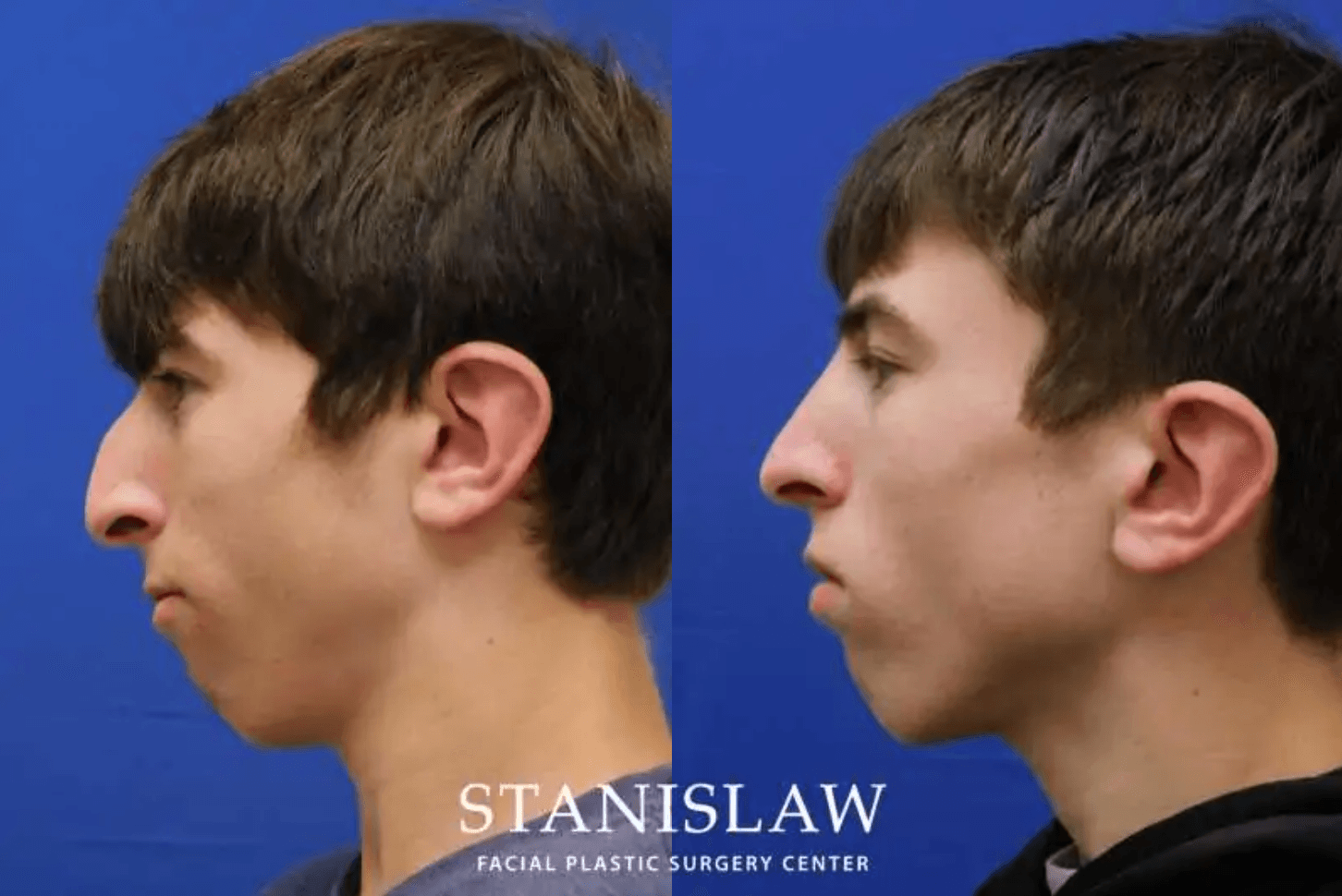 Facelift Connecticut: Dr. Paul Stanislaw photo 1 of 8