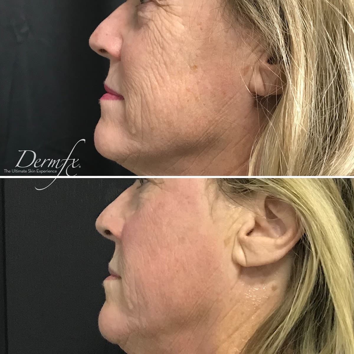 DermFx