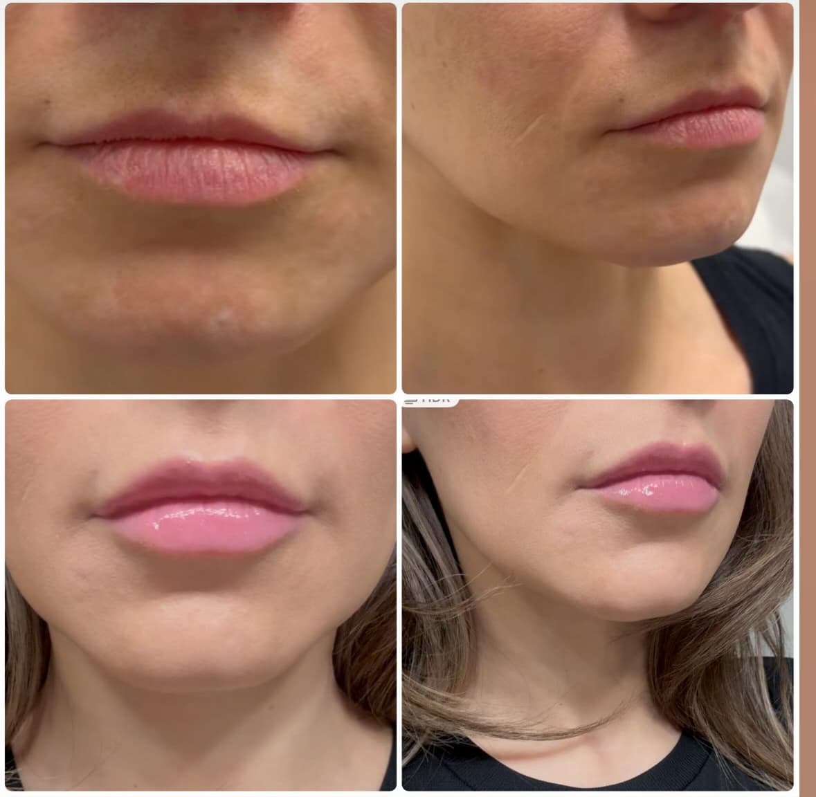 HD Beauty Phoenix Aesthetics & Botox