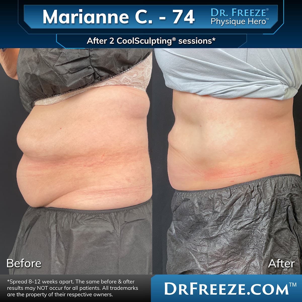 Dr. Freeze® CoolSculpting Center - Solana Beach, CA
