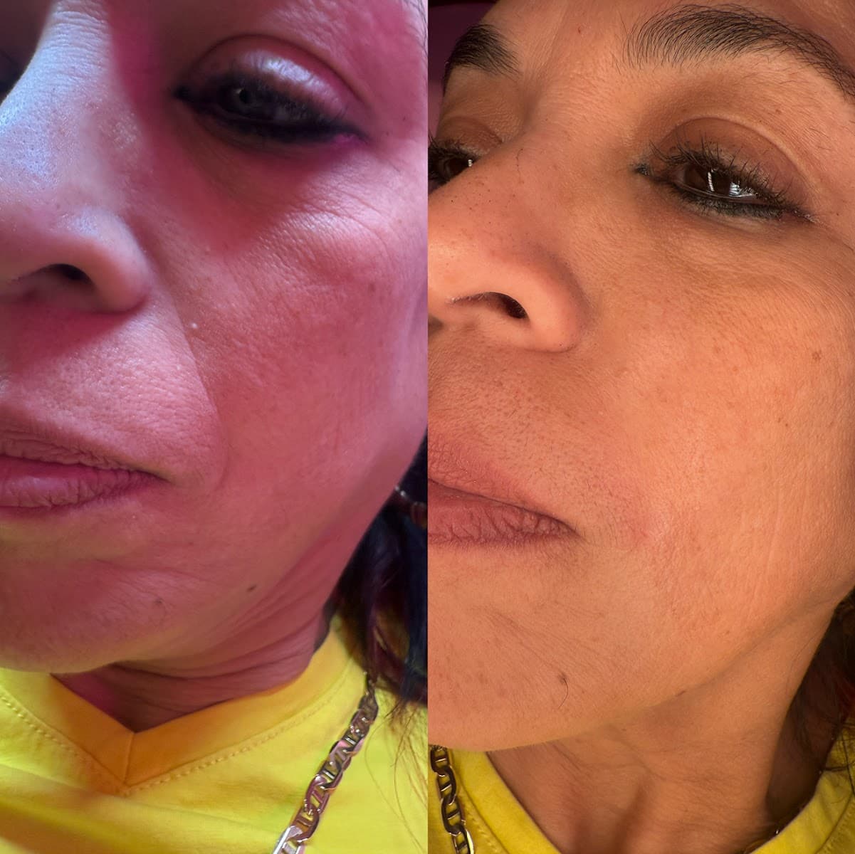 Texas Needle Queen • Botox & Lip Filler Clinic | Round Rock, TX