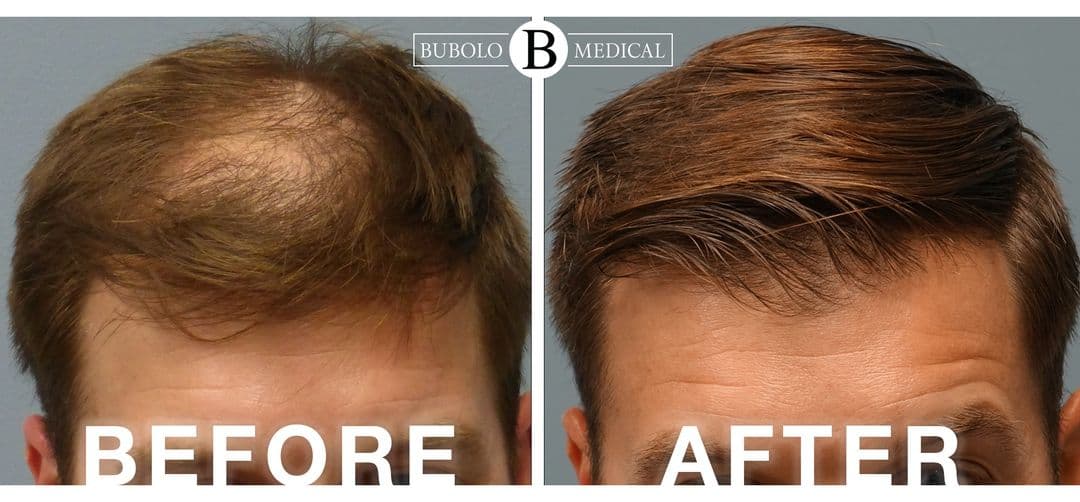 Bubolo Hair Restoration