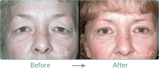 Eyesthetica - Los Angeles Eyelid Surgery photo 1 of 8