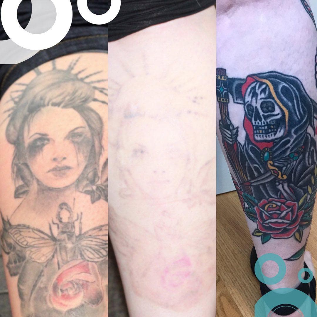 Removery Tattoo Removal & Fading