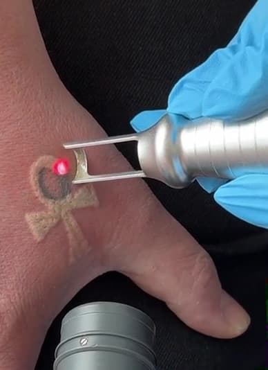 Skin City 13 & Laser tattoo removal