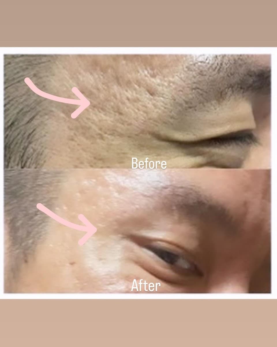 Ezinjections