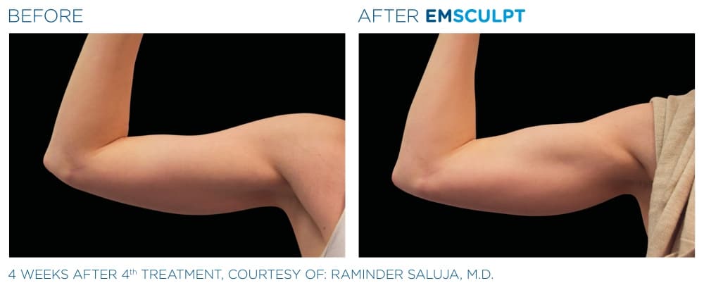 Houston EMSculptors