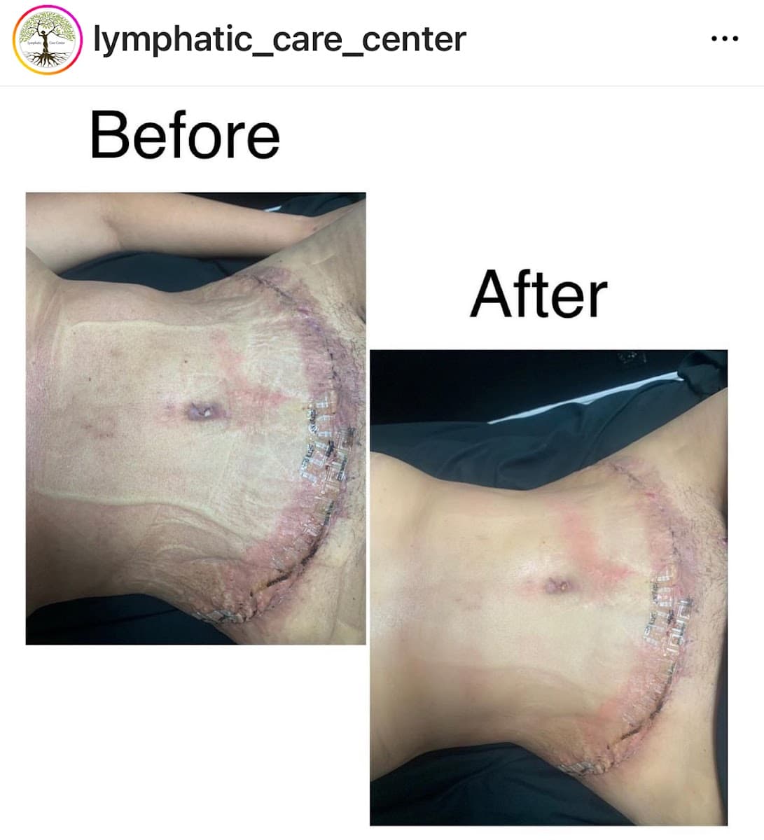 Lymphatic Care Center
