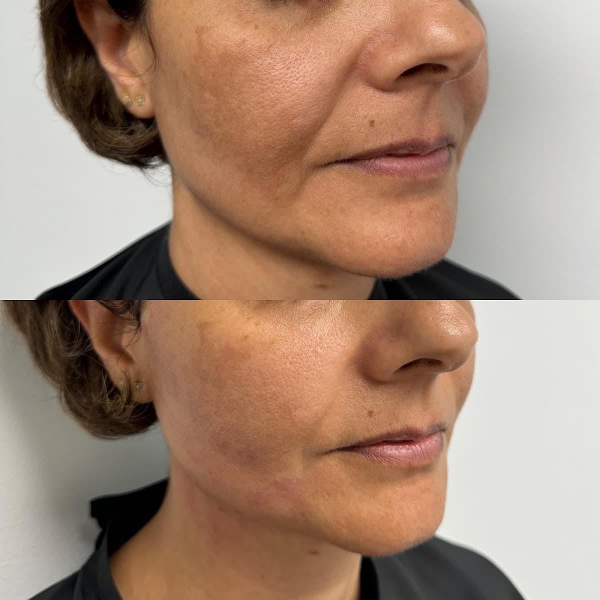 Beautox and Fillers of Charlotte photo 1 of 8