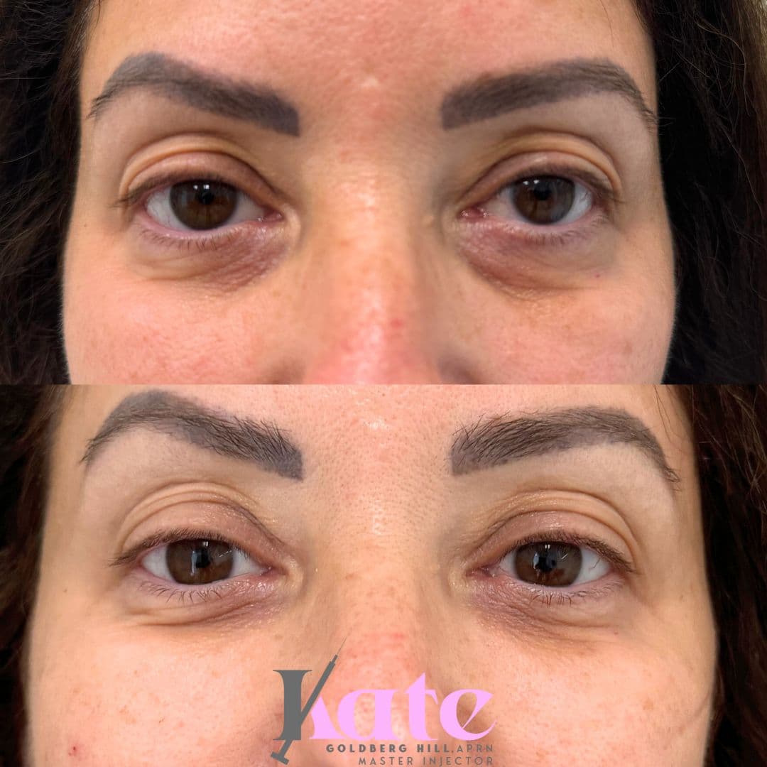 Kate Goldberg Hill, APRN at 5th Avenue Plastic Surgery @BocaBotox