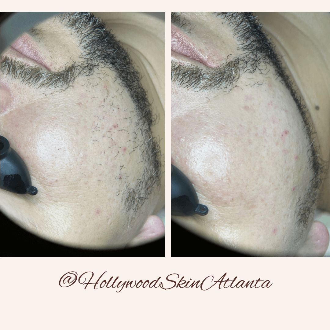 Hollywood Skin Atlanta