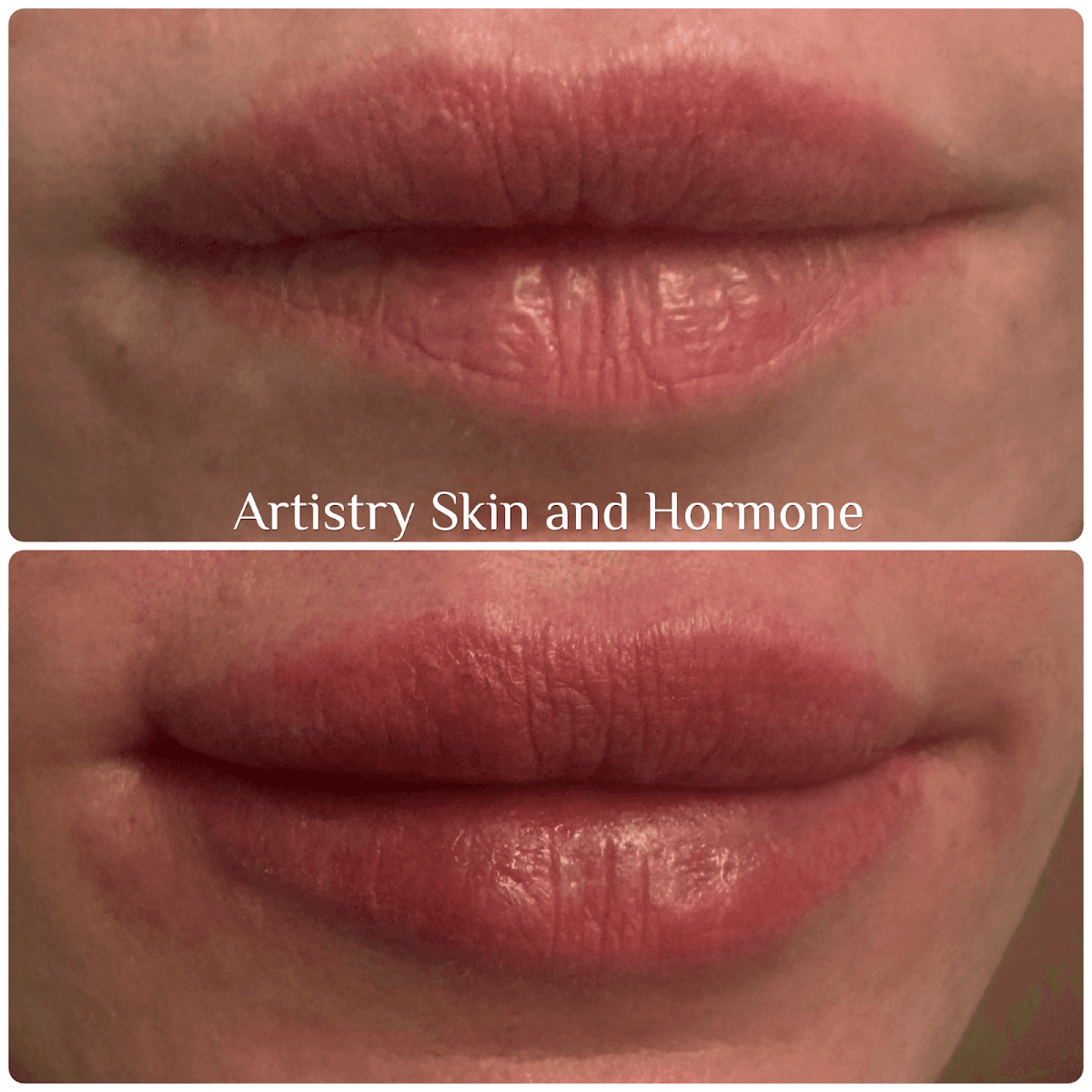 Artistry Skin and Hormone