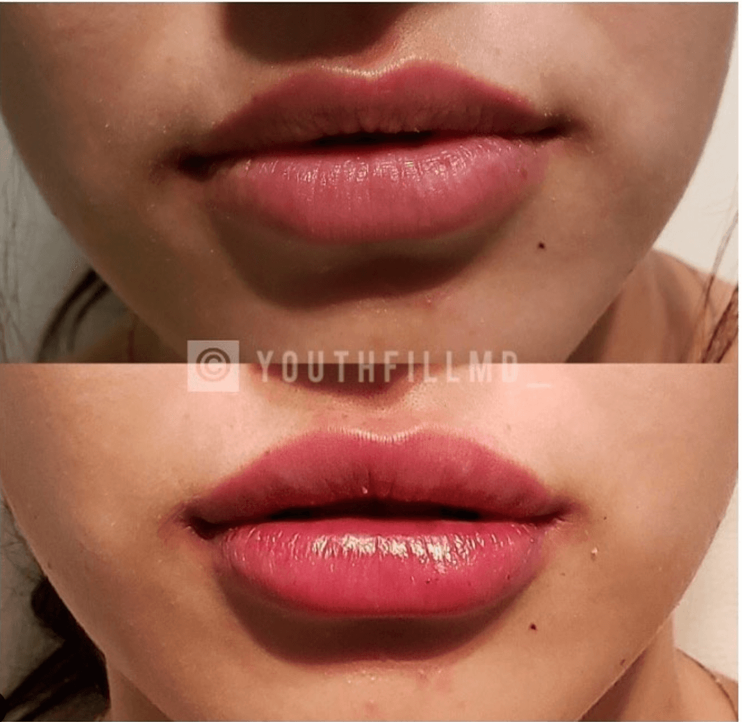 YouthFill MD Med Spa - Beverly Hills