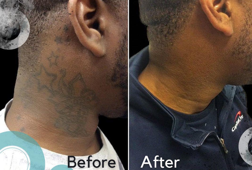 Removery Tattoo Removal & Fading