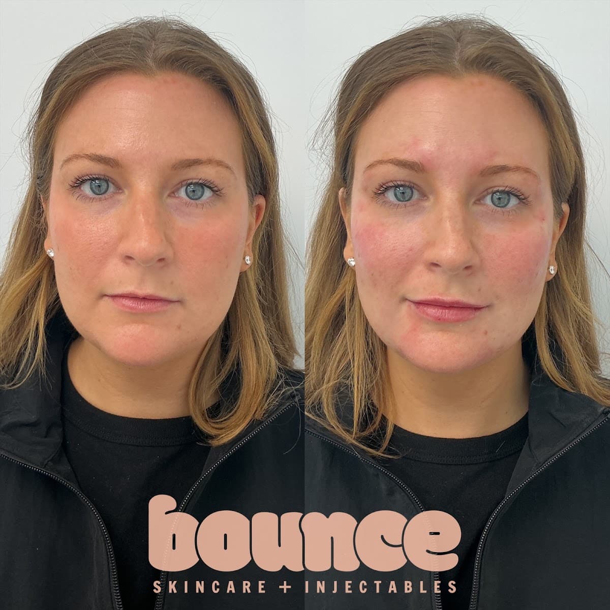 Bounce Skincare and Injectables