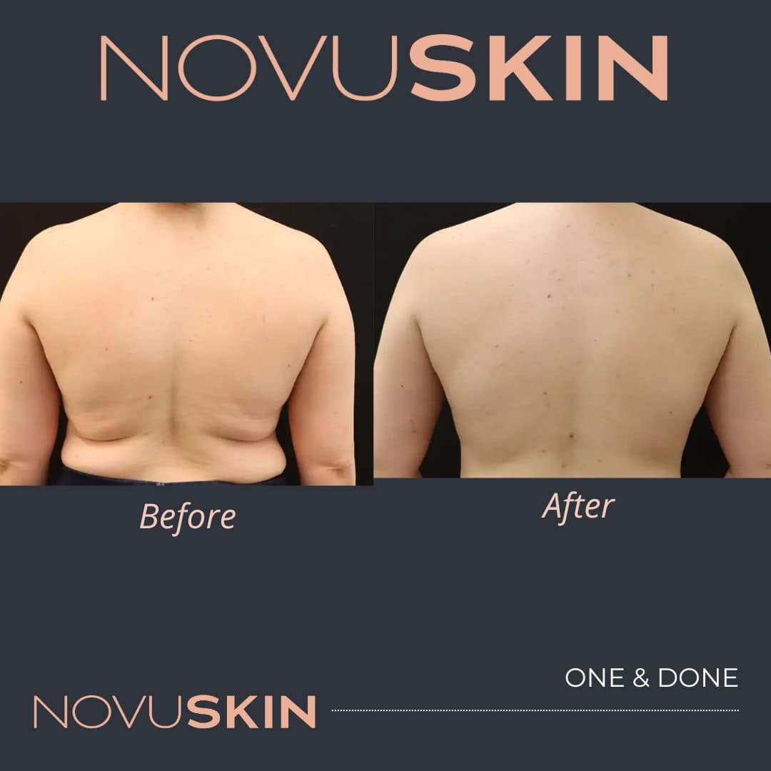Novuskin