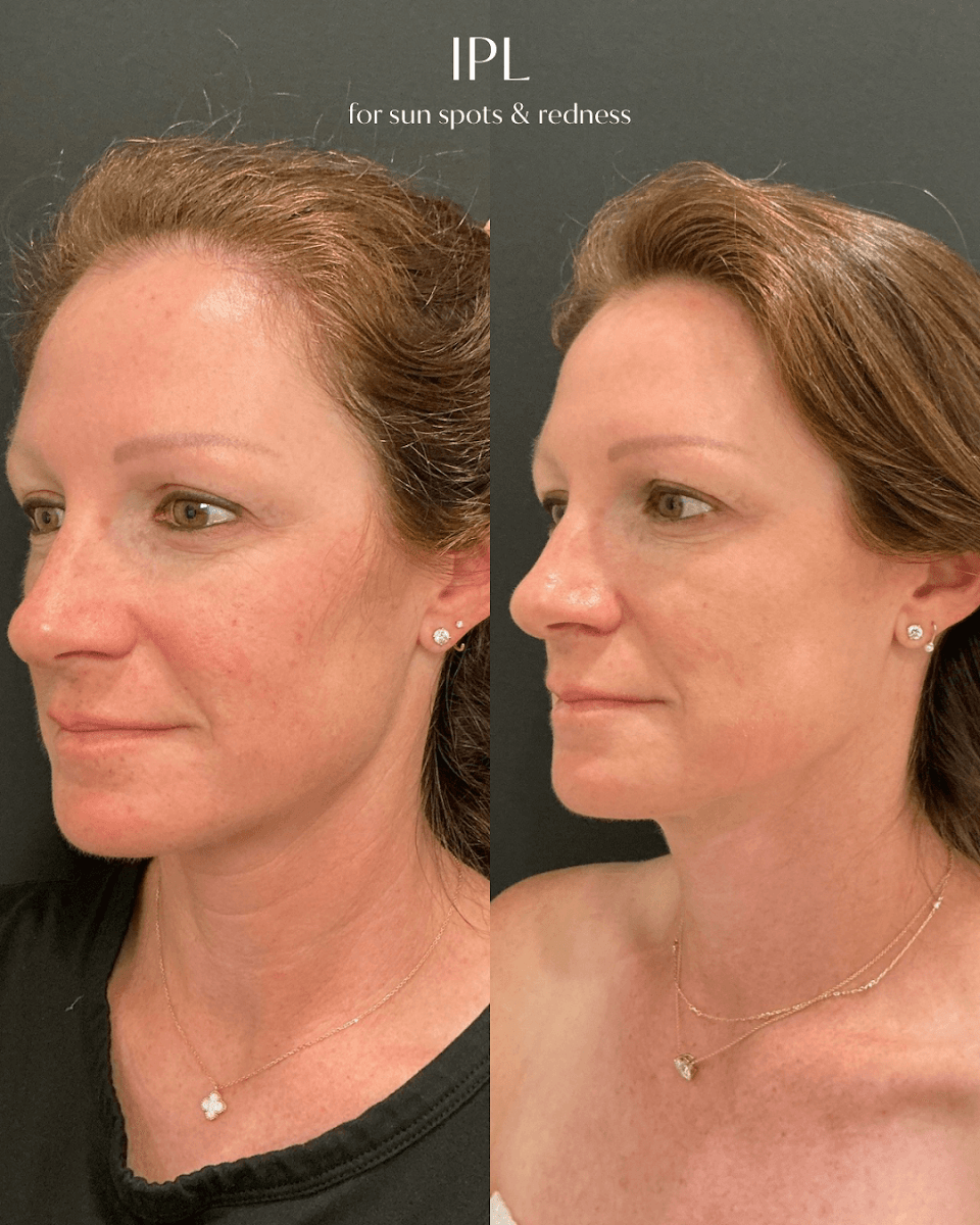 Injection Perfection Medical Spa